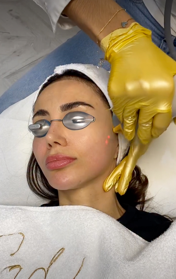 Φωτοανανέωση (IPL), IG @sadaf_jaffari | Treatwell