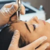 &Kappa;&omicron;&nu;&tau;&iota;&nu;ό &pi;&lambda;ά&nu;&omicron; &epsilon;&pi;&alpha;&gamma;&gamma;&epsilon;&lambda;&mu;&alpha;&tau;&iota;&kappa;ή&sigmaf; &theta;&epsilon;&rho;&alpha;&pi;&epsilon;ί&alpha;&sigmaf; microneedling &sigma;&tau;&omicron; &pi;&rho;ό&sigma;&omega;&pi;&omicron; &gamma;&upsilon;&nu;&alpha;ί&kappa;&alpha;&sigmaf; &sigma;&epsilon; &kappa;&lambda;&iota;&nu;&iota;&kappa;ή