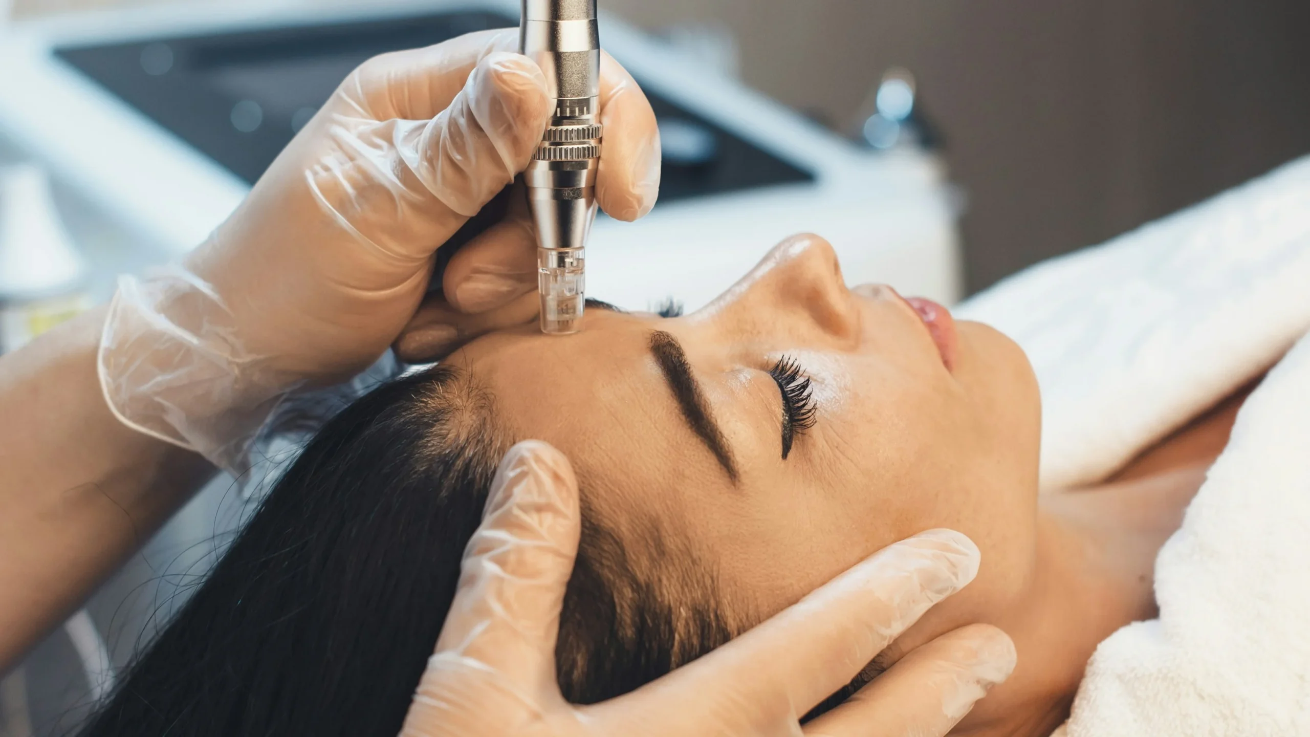Κοντινό πλάνο επαγγελματικής θεραπείας microneedling στο πρόσωπο γυναίκας σε κλινική